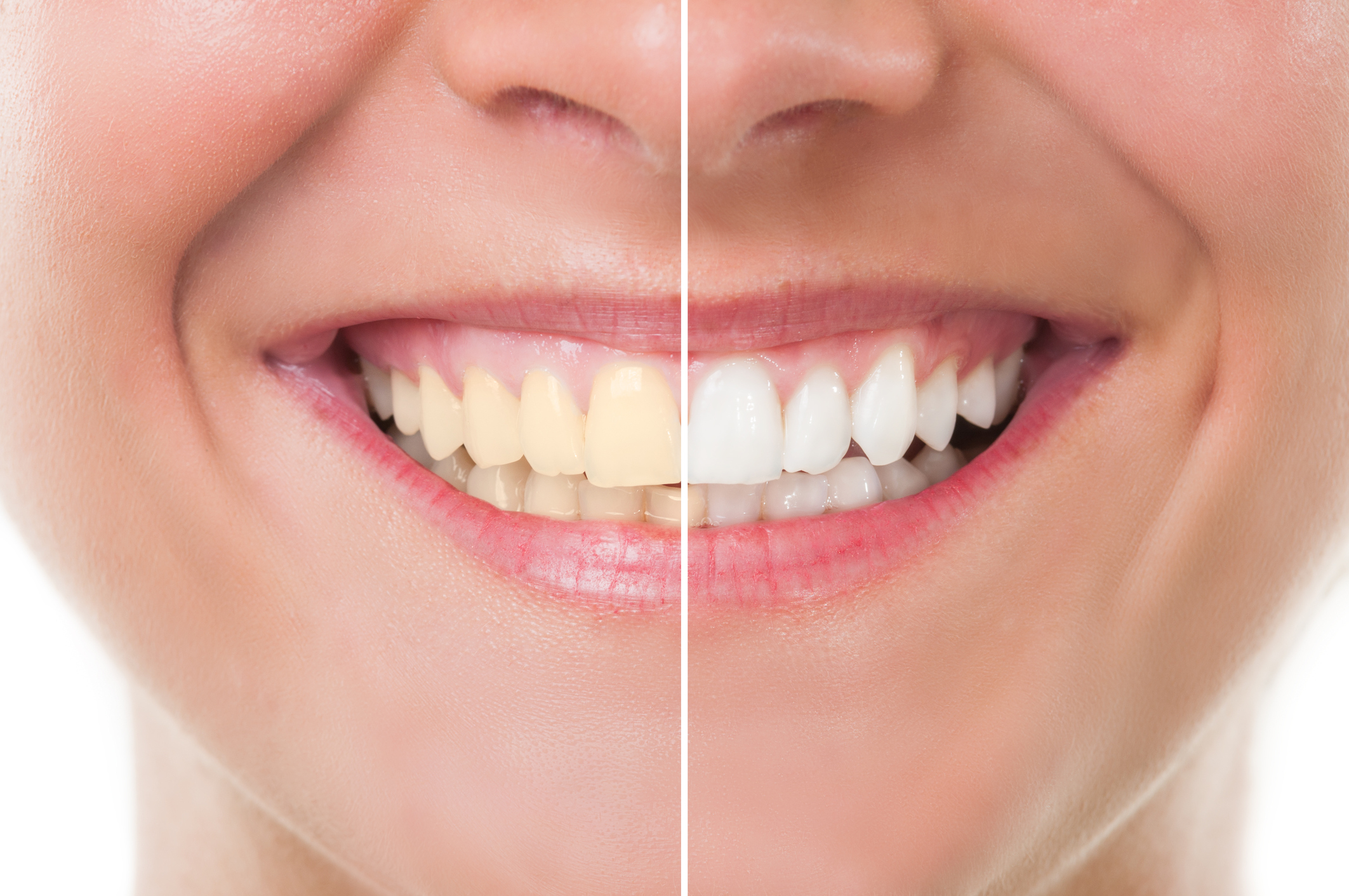 What is Dental Bleaching Procedure, Cost, Effectiveness & More